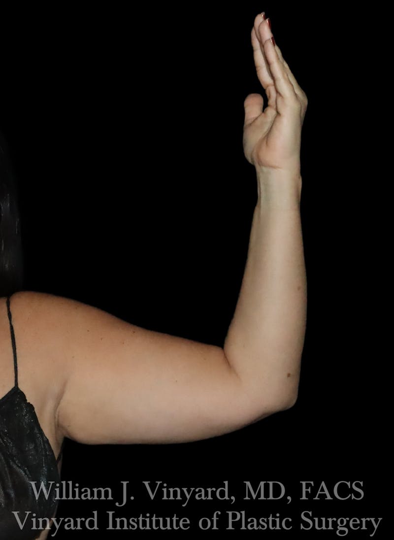 BODYTite / Liposuction Before & After Gallery - Patient 260646 - Image 6