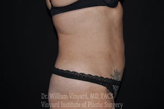 BODYTite / Liposuction Before & After Gallery - Patient 169755653 - Image 4