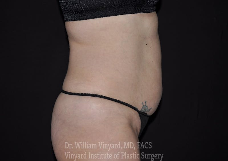 BODYTite / Liposuction Before & After Gallery - Patient 169755653 - Image 3