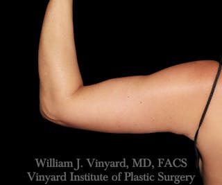 Arm Lift Before & After Gallery - Patient 256749 - Image 2