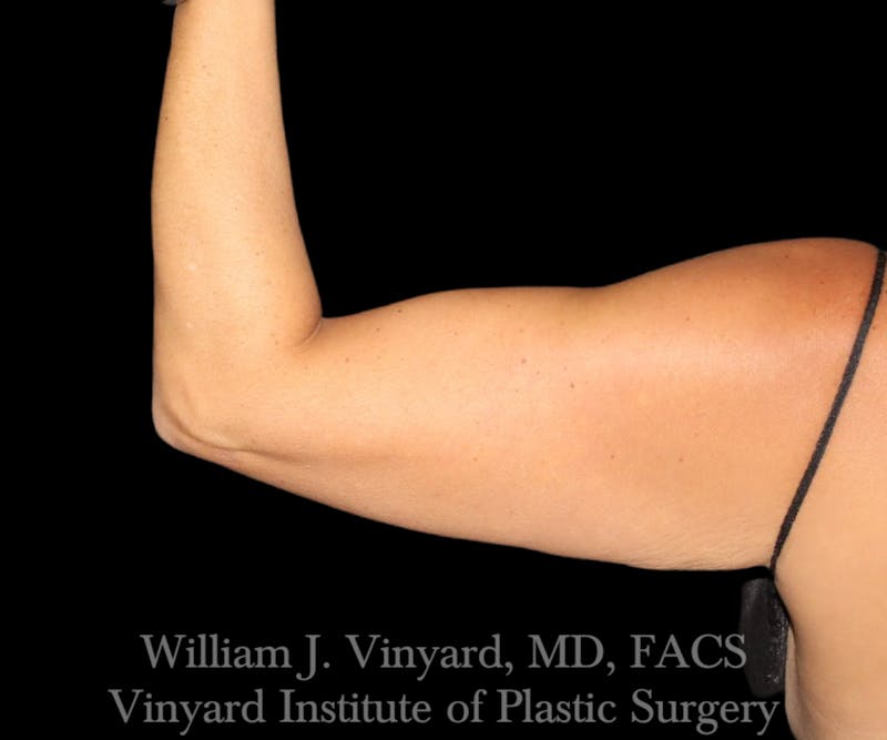 Arm Lift Before & After Gallery - Patient 256749 - Image 1
