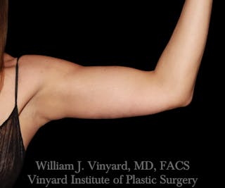 Arm Lift Before & After Gallery - Patient 256749 - Image 6