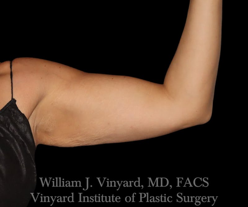Arm Lift Before & After Gallery - Patient 256749 - Image 5