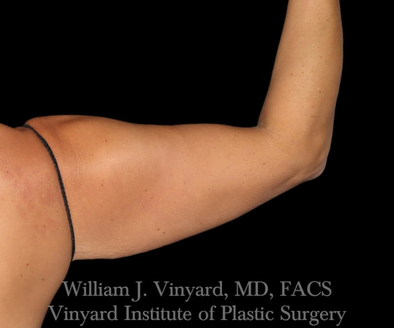 Arm Lift Before & After Gallery - Patient 256749 - Image 3