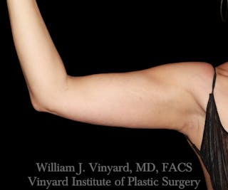 Arm Lift Before & After Gallery - Patient 256749 - Image 8