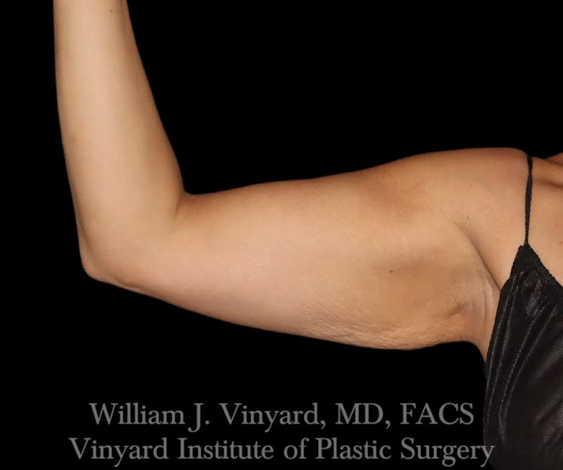Arm Lift Before & After Gallery - Patient 256749 - Image 7