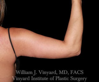 Arm Lift Before & After Gallery - Patient 256749 - Image 4