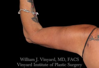 Arm Lift Before & After Gallery - Patient 256702 - Image 6