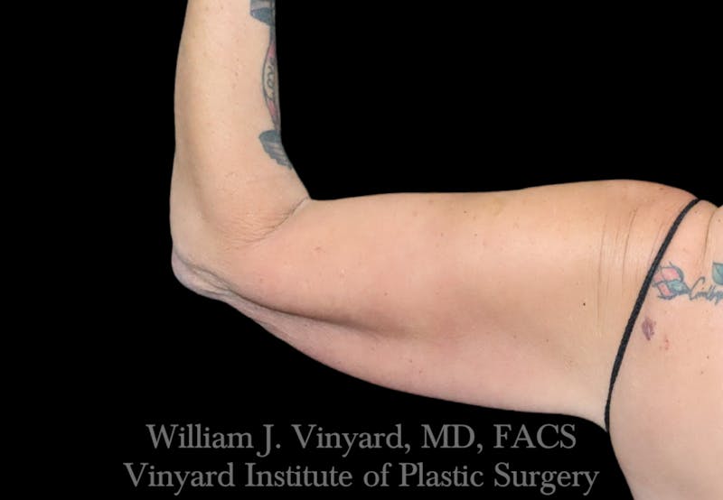 Arm Lift Before & After Gallery - Patient 256702 - Image 5