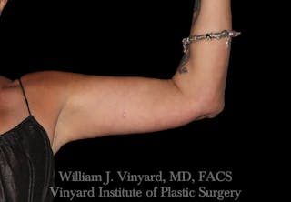 Arm Lift Before & After Gallery - Patient 256702 - Image 4