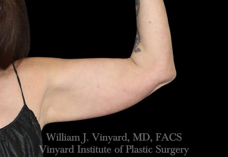 Arm Lift Before & After Gallery - Patient 256702 - Image 3