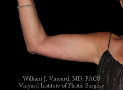 Arm Lift Before & After Gallery - Patient 256702 - Image 2