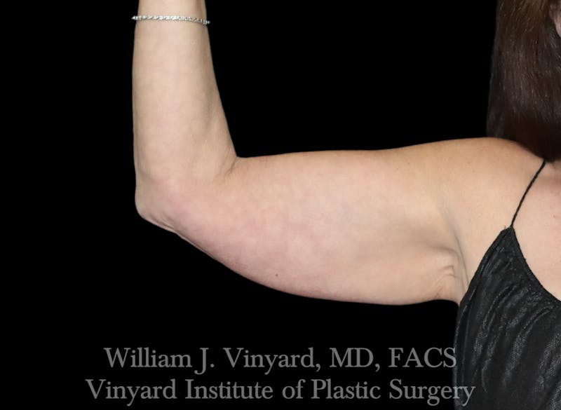 Arm Lift Before & After Gallery - Patient 256702 - Image 1
