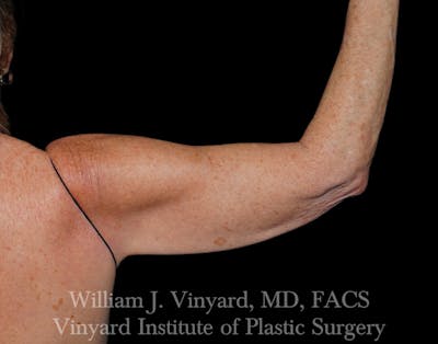 Arm Lift Before & After Gallery - Patient 308951 - Image 1
