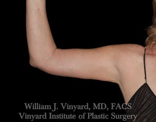 Arm Lift Before & After Gallery - Patient 308951 - Image 4