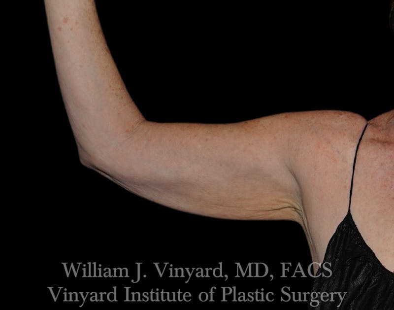 Arm Lift Before & After Gallery - Patient 308951 - Image 3
