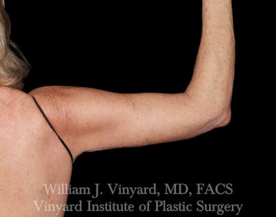 Arm Lift Before & After Gallery - Patient 308951 - Image 2