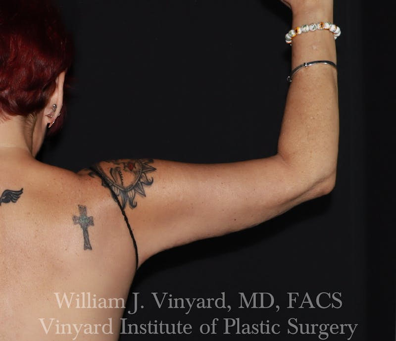 Arm Lift Before & After Gallery - Patient 127580 - Image 2
