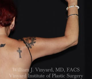 Arm Lift Before & After Gallery - Patient 127580 - Image 2