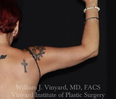 Arm Lift Before & After Gallery - Patient 127580 - Image 2