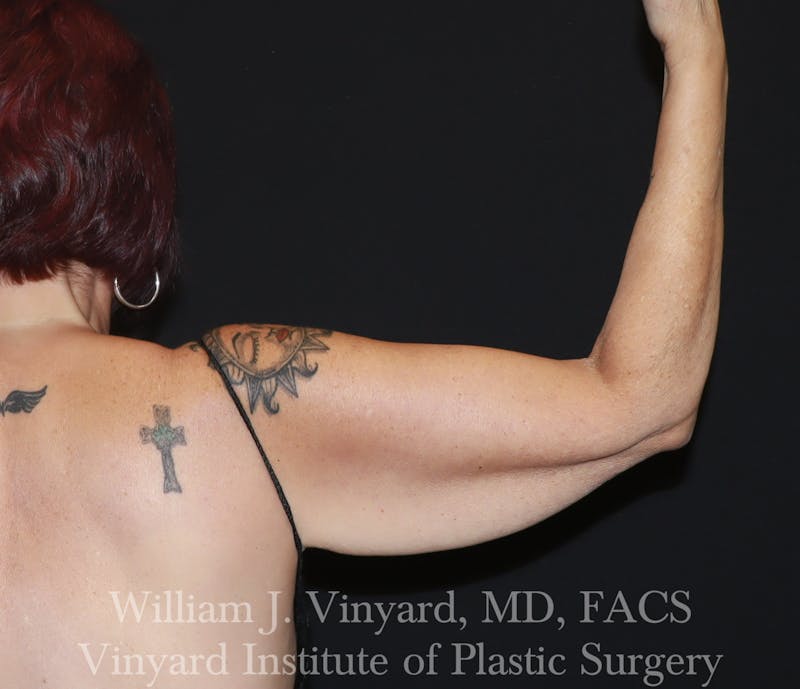 Arm Lift Before & After Gallery - Patient 127580 - Image 1
