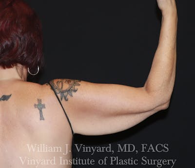 Arm Lift Before & After Gallery - Patient 127580 - Image 1