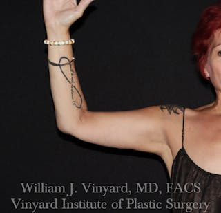 Arm Lift Before & After Gallery - Patient 127580 - Image 4