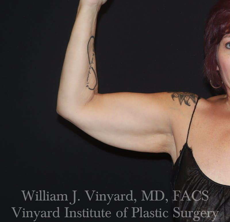 Arm Lift Before & After Gallery - Patient 127580 - Image 3