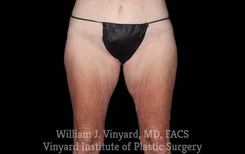 Thigh Lift/Lower Body Lift Before & After Gallery - Patient 392435 - Image 1