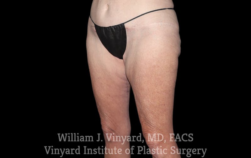 Thigh Lift/Lower Body Lift Before & After Gallery - Patient 392435 - Image 4