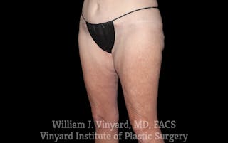 Thigh Lift/Lower Body Lift Before & After Gallery - Patient 392435 - Image 4