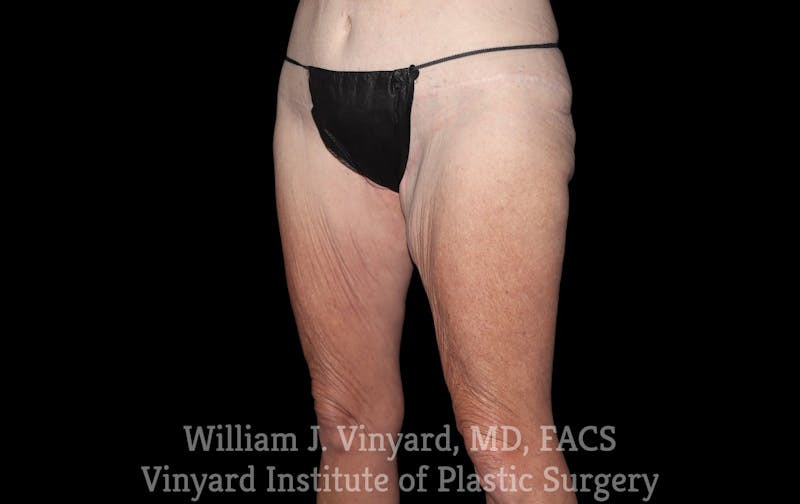 Thigh Lift/Lower Body Lift Before & After Gallery - Patient 392435 - Image 3