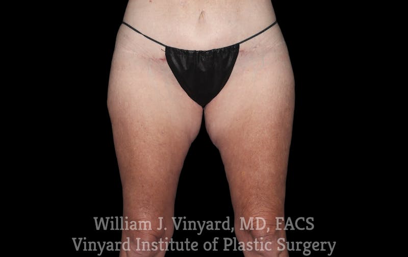 Thigh Lift/Lower Body Lift Before & After Gallery - Patient 392435 - Image 2