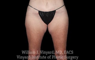 Thigh Lift/Lower Body Lift Before & After Gallery - Patient 392435 - Image 2