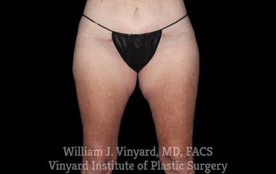 Thigh Lift/Lower Body Lift Before & After Gallery - Patient 392435 - Image 2