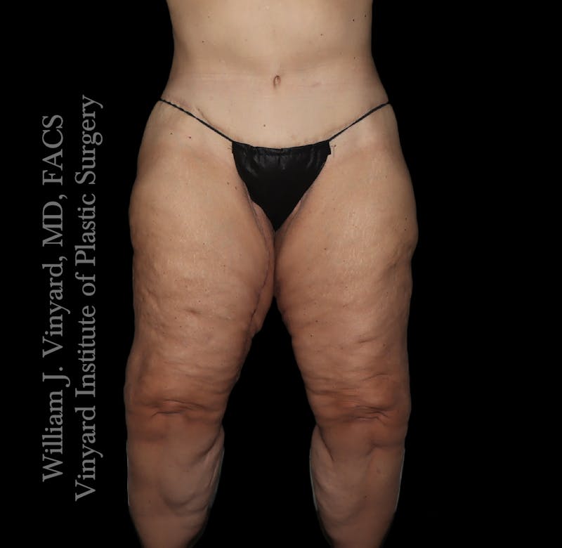 Thigh Lift/Lower Body Lift Before & After Gallery - Patient 253077 - Image 2