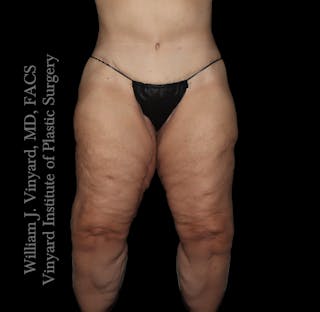 Thigh Lift/Lower Body Lift Before & After Gallery - Patient 253077 - Image 2