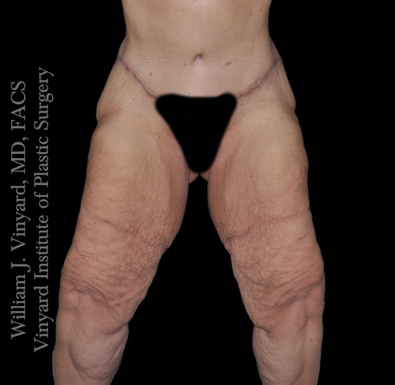 Thigh Lift/Lower Body Lift Before & After Gallery - Patient 253077 - Image 1