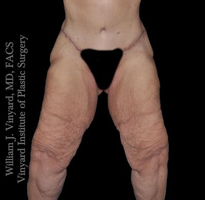 Thigh Lift/Lower Body Lift Before & After Gallery - Patient 253077 - Image 1