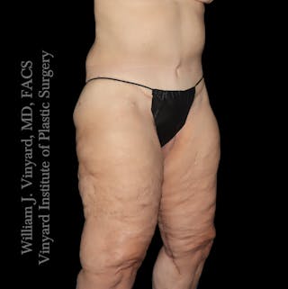 Thigh Lift/Lower Body Lift Before & After Gallery - Patient 253077 - Image 4