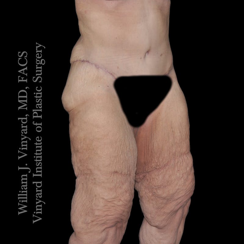 Thigh Lift/Lower Body Lift Before & After Gallery - Patient 253077 - Image 3