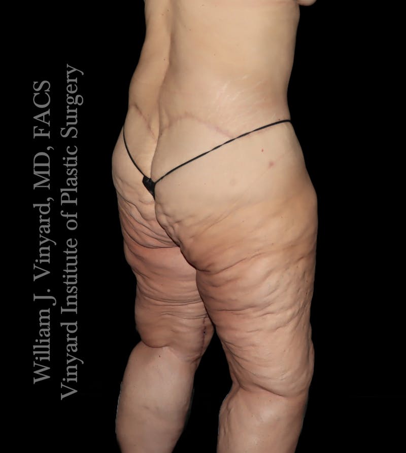 Thigh Lift/Lower Body Lift Before & After Gallery - Patient 253077 - Image 6