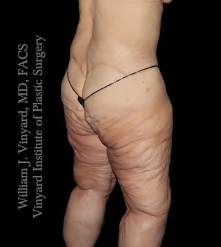 Thigh Lift/Lower Body Lift Before & After Gallery - Patient 253077 - Image 6