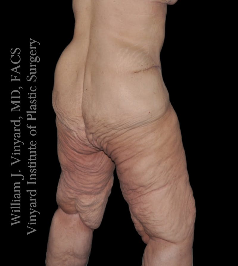 Thigh Lift/Lower Body Lift Before & After Gallery - Patient 253077 - Image 5