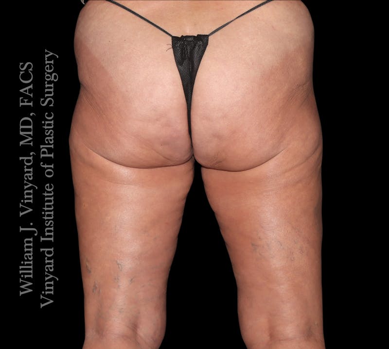 Thigh Lift/Lower Body Lift Before & After Gallery - Patient 351094 - Image 6