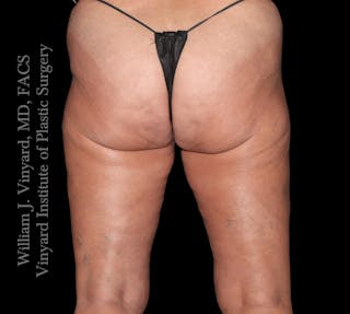 Thigh Lift/Lower Body Lift Before & After Gallery - Patient 351094 - Image 6
