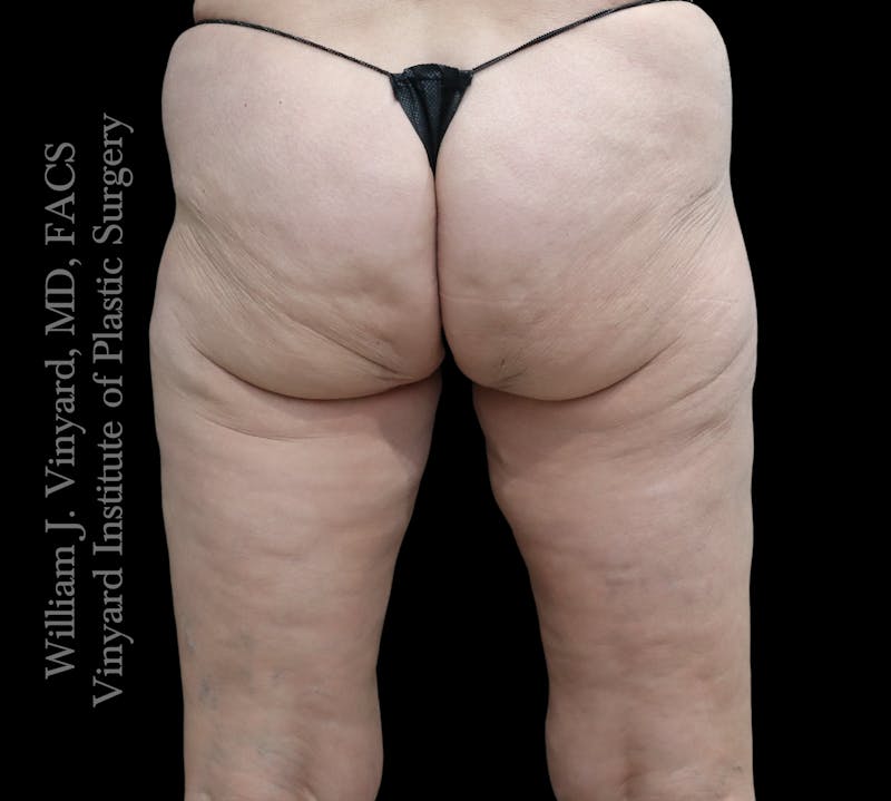 Thigh Lift/Lower Body Lift Before & After Gallery - Patient 351094 - Image 5