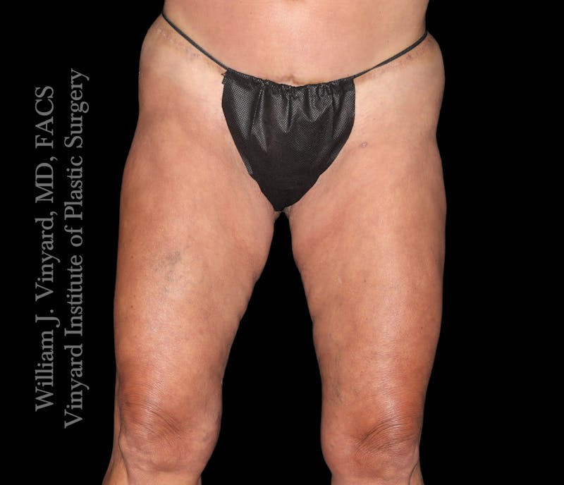 Thigh Lift/Lower Body Lift Before & After Gallery - Patient 351094 - Image 2