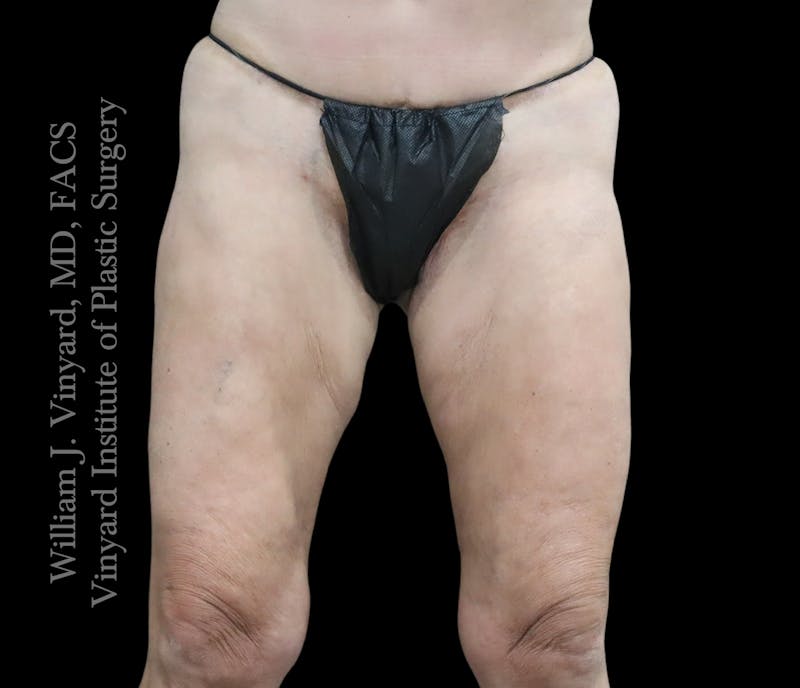 Thigh Lift/Lower Body Lift Before & After Gallery - Patient 351094 - Image 1