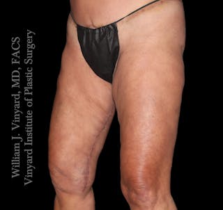 Thigh Lift/Lower Body Lift Before & After Gallery - Patient 351094 - Image 4